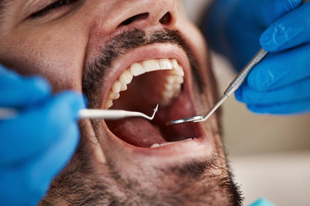 Best Urgent Care for Lost Fillings or Crowns in Keystone, FL